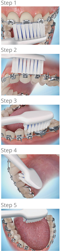 brushing steps - Petaluma Orthodontics