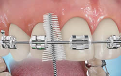 Proxabrush recommendation by Petaluma Orthodontics