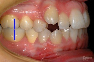 Bite Classifications - Petaluma Orthodontics