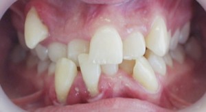 Common Problems - Petaluma Orthodontics