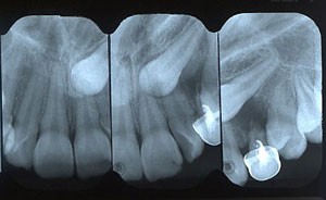 Impacted Teeth - Petaluma Orthodontics