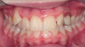 Impacted Teeth - Petaluma Orthodontics