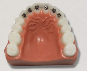 Lingual Braces - Petaluma Orthodontics