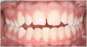 Common Problems - Petaluma Orthodontics