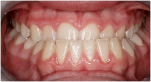 Common Problems - Petaluma Orthodontics